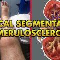 What Is FSGS? Know the Causes and Best Treatment Options