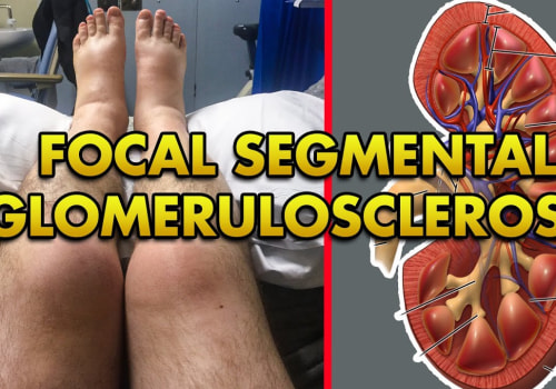 What Is FSGS? Know the Causes and Best Treatment Options